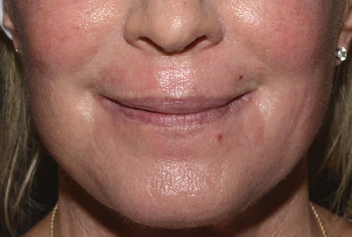 Fractional CO2 Laser - One Week After Treatment