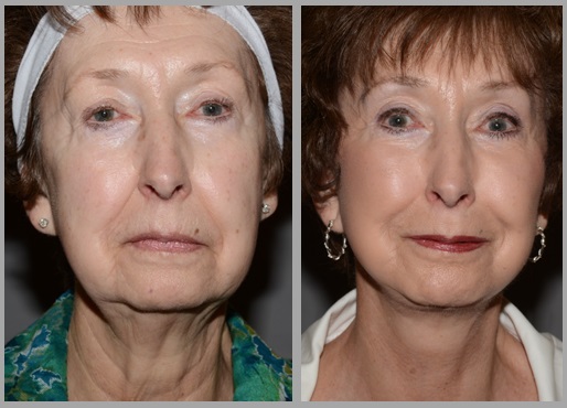 Facelift Necklift Before After - Neal D. Goldman, M.D. - Facial Plastic Surgeon - Goldman Center for Facial Plastic Surgery