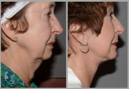 Facelift Necklift Before After - Neal D. Goldman, M.D. - Facial Plastic Surgeon - Goldman Center for Facial Plastic Surgery