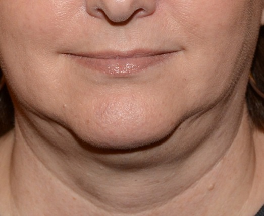 Kybella Before - Neal D Goldman, M.D. - Facial Plastic Surgeon - Goldman Center for Facial Plastic Surgery