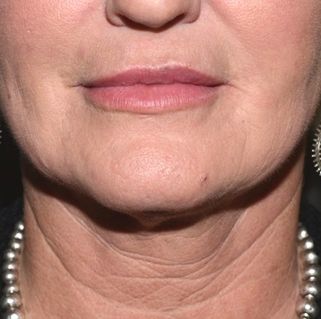 Kybella After - Neal D Goldman, M.D. - Facial Plastic Surgeon - Goldman Center for Facial Plastic Surgery