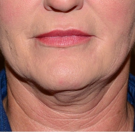 Kybella Before - Neal D Goldman, M.D. - Facial Plastic Surgeon - Goldman Center for Facial Plastic Surgery